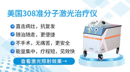 308准分子激光治疗仪哪个品牌好