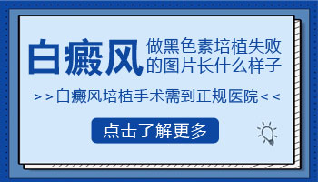 黑色素细胞培植治疗白癜风效果怎么样