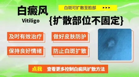 耳朵上长了白癜风会长到脸上吗