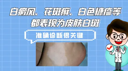 白斑是白癜风吗 各种白斑图