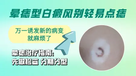 晕痣把痣点了白斑会慢慢恢复吗