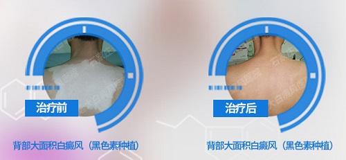 白癜风治疗一个月有什么效果