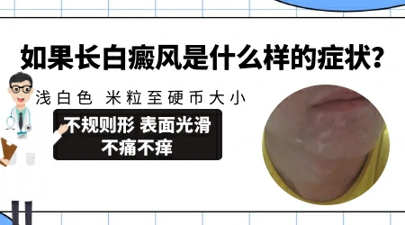 白斑一定会发展成白癜风吗