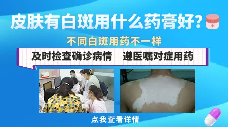 祛白酊小孩可以用吗 儿童白癜风治疗方法