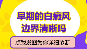 分型治疗白癜风，事半功倍效果好