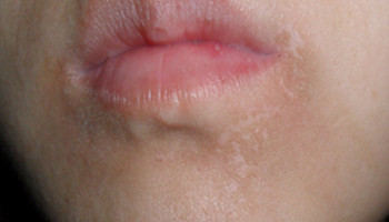 口唇白斑初期症状图片图片