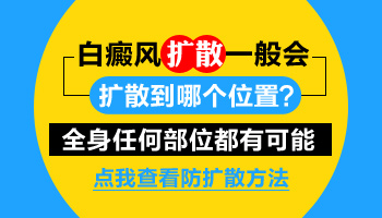 白癜风如果扩散是随机扩散还是只在周边扩散