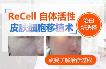 308激光治疗白癜风为什么还是很慢