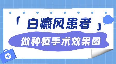 白斑做移植手术怎么收费