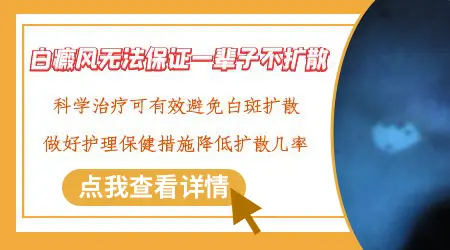 白癜风几年没扩散还会扩散吗