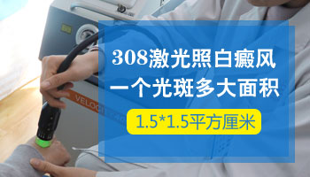 308激光照白斑一次多大面积 照一回白斑多少钱 