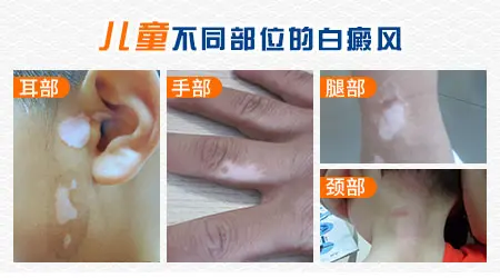 小孩白癜风症状 白癜风图