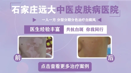 白癜风现在没有扩散以后会吗