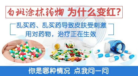 白癜风照光后多久可以涂药