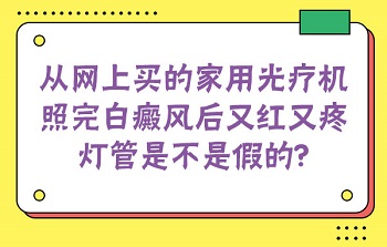 家用白癜风治疗仪有仪器买吗