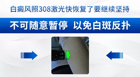 308光疗仪治白癜风管不管用