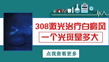 308激光治療白癜風是通過激光光束照射在白斑患處,有效誘導t淋巴細胞