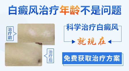 308激光治疗白斑效果怎么样