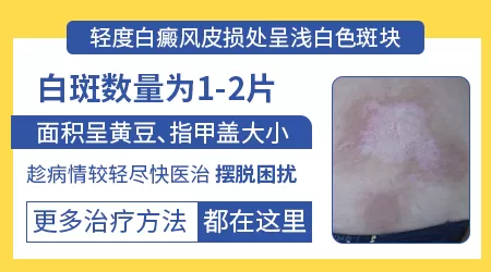 白癜风怎么治疗ZUI快