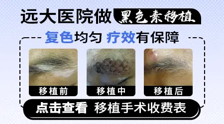 黑色素细胞移植可以治疗白癜风吗