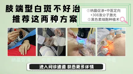 中药渗透治疗白癜风是什么方法