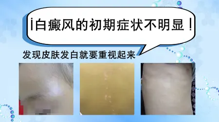 白癜风用手搓后什么颜色