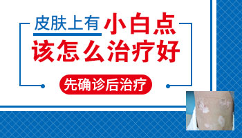 眼尾长白斑图片 白斑怎么治疗好