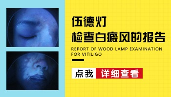 wood灯是检查什么的 能确诊白斑吗