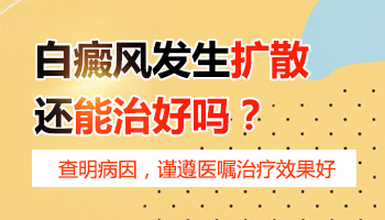 手指白癜风有扩散迹象如何治疗