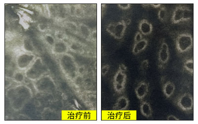 额头白斑照激光没效果是什么原因