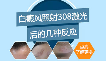 白斑做了308准分子激光之后有何反应