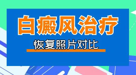 石家庄皮肤病医院看白斑怎么样