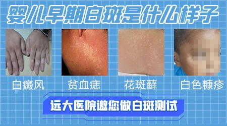 婴儿大腿内侧白斑