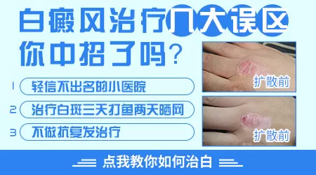 白癜风怎么治疗能断根