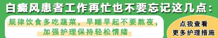 屁股上面一点白癜风能治好吗