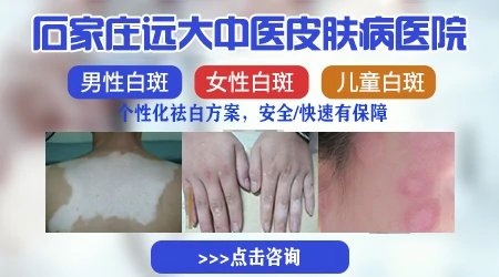 石家庄有几家医院治白癜风