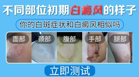 女性皮肤白斑是什么原因引起的