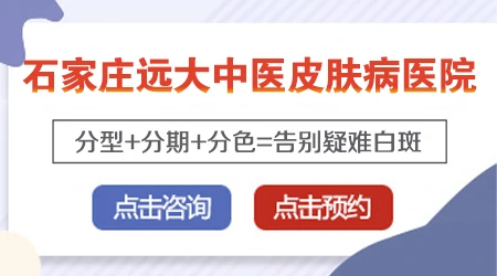 对称型白癜风是不是很难治疗