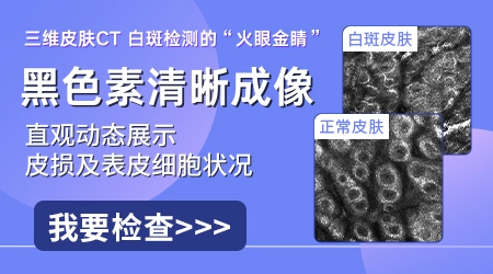 伍德氏灯照白斑蓝白色是白癜风吗