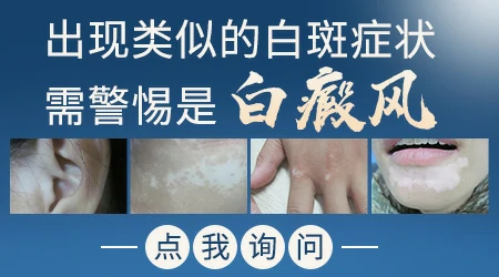 为什么鼻梁骨发白