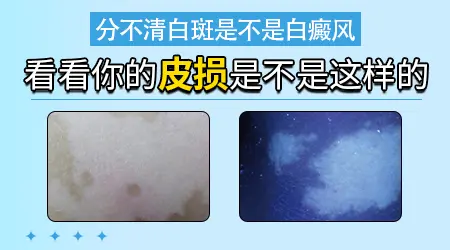 男生大腿光滑的白斑是不是白癜风