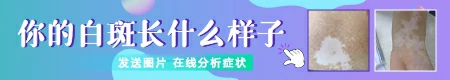 皮肤白了一块怎么回事 各种白斑图