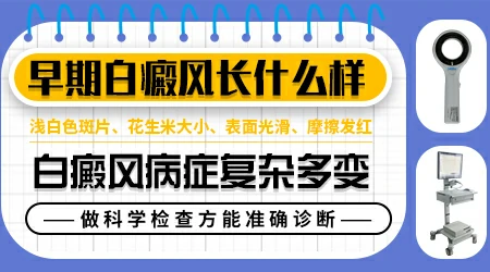 白斑是不是白癜风 长白斑的原因